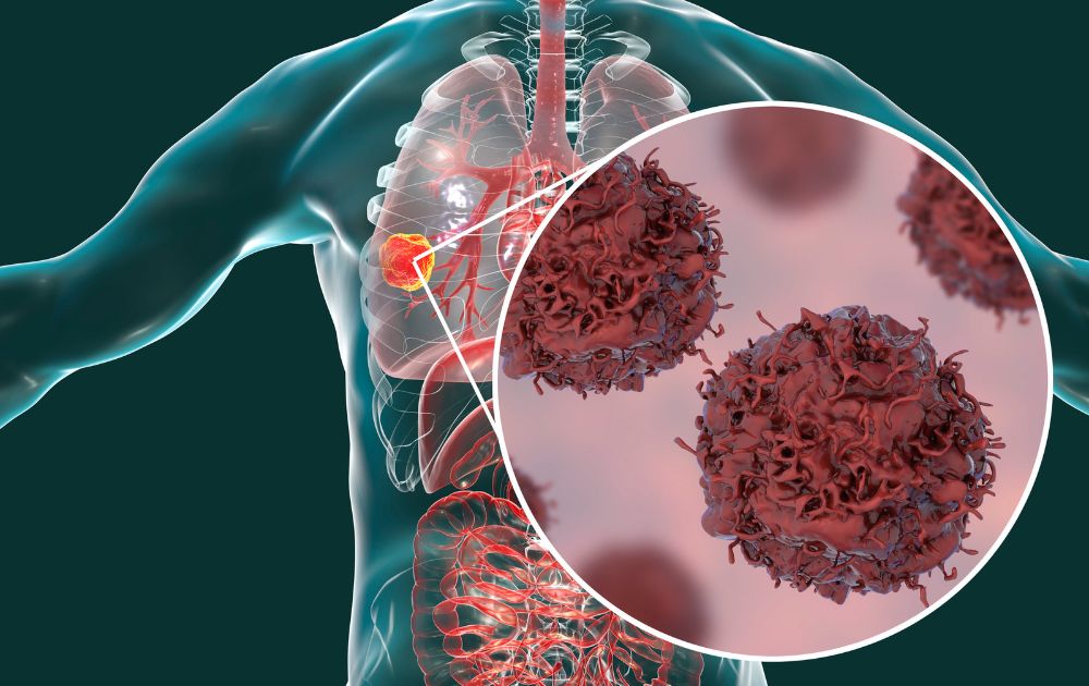 Cáncer de pulmón: la prevención pasa por un futuro sin tabaco - IOB Madrid